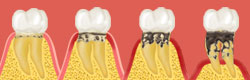 歯周病治療