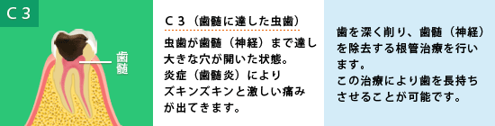 Ｃ３（歯髄に達した虫歯）