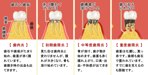 歯周病の進行図