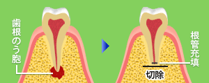 歯根のう胞摘出術
