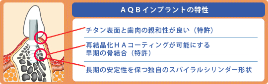 ＡＱＢインプラントの特性