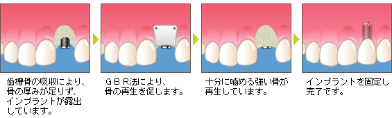 骨誘導再生療法（ＧＢＲ法）