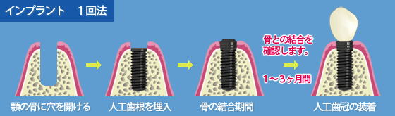 インプラント１回法