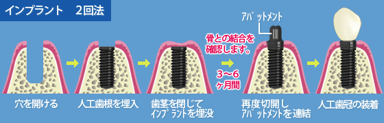 インプラント２回法