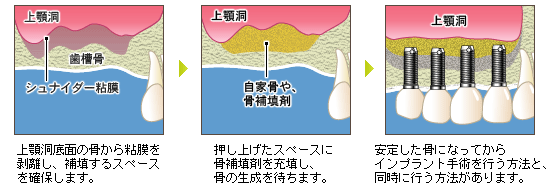 サイナスリフト法