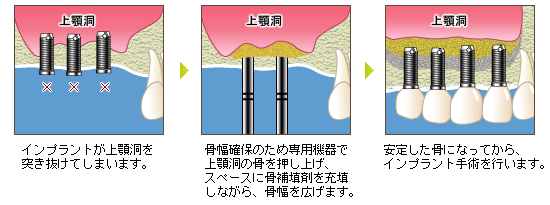 ソケットリフト法